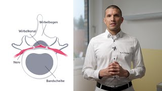 Behandlungsmöglichkeiten der Spinalkanalstenose [upl. by Maggi]