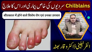 Chilblains Causes Symptoms and Homeopathic Treatments by Dr Waqar Bhutta [upl. by Urson]