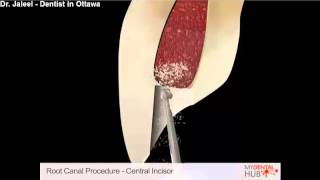 Endodontics  Root Canal Procedure Central Incisor  Dentist Ottawa [upl. by Schreibman]