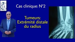 Cas clinique Tumeurs extrémité distale du radius [upl. by Libnah]