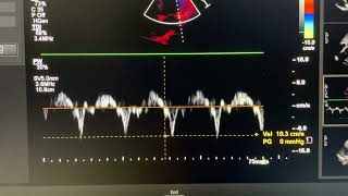 Annulus paradoxus motion in constrictive pericarditis [upl. by Amargo566]