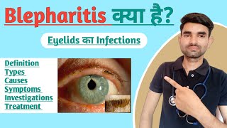 Blepharitis in Hindi  Causes Symptoms And Treatment of Blepharitis [upl. by Minnaminnie]