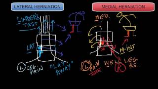 Lateral vs Medial Disc Herniations [upl. by Annahsit206]