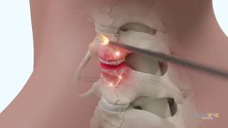 Cervical Deuk Plasma Rhizotomy DPR C3C4 C4C5 for Neck Pain from Facet Joint Arthropathy [upl. by Zelma]