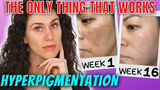 The ONLY Ingredients That Stop Hyperpigmentation And Reverse It [upl. by Monique]