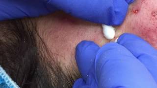 Blackhead Extractions on Leslie [upl. by Anner]