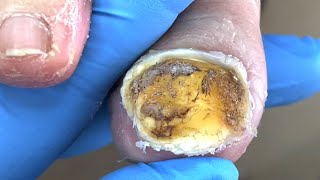 Trimming large areas of onychomycosis [upl. by Godiva]