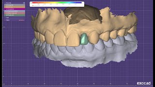 Maryland bridge designing in exocad [upl. by Padraic]