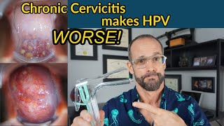 HPV combined with chronic cervicitis increases the risk of severe dysplasia and cervical cancer [upl. by Nueormahc]