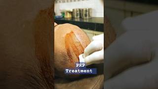 After hair PRP treatment hairecare short viralvideo explorepage [upl. by Raycher]