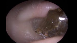 Man Gets Satisfying Ear Wax Removal [upl. by Drarehs283]