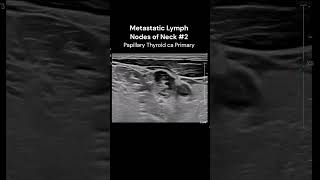 Neck Lymph Nodes2 ultrasound imaging cancer [upl. by Claresta]