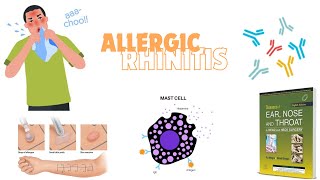 ALLERGIC RHINITISSEASONAL OR PERENNIALEARLY OR DELAYED udaipurwala dhingra otorhinolaryngology [upl. by Eanwahs]