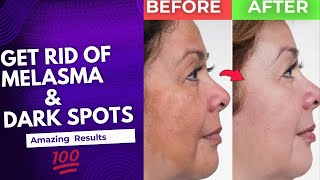 How to Treat MELASMA HYPERPIGMENTATIONDark SPOTS at home CAUSES amp prevention Detailed video [upl. by Atlee]