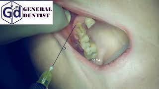 Infiltration anesthesia for extraction 12 tooth [upl. by Yrallih256]