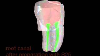 VDW Dental · MicroCTScan of a lower molar clinical video [upl. by Freudberg]