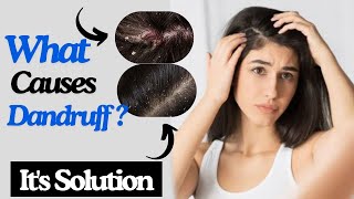 Top Reasons For Dandruff amp How To Fix It Naturally ✨ 😌 [upl. by Radferd]