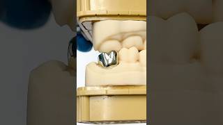 Gold Molar EnvisiontecMain envisiontec lsk121shorts dentist teeth [upl. by Norse645]