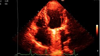 Ball and Cage Mitral Valve Prosthesis  Echocardiography [upl. by Roter745]