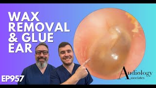 WAX REMOVAL AND GLUE EAR WHAT IS GLUE EAR  EP957 [upl. by Clint]