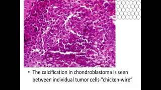 Chondroblastoma shows Chiken wire calcification [upl. by Frasquito]