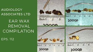 EAR WAX REMOVAL COMPILATION  EP 112 [upl. by Ylaek1]