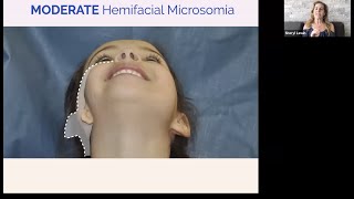 Live Chat Hemifacial Microsomia and PIER for Microtia [upl. by Berlyn792]