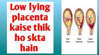 low lying placenta कैसे ठीक हो सकता है low lying placenta risk and precautions [upl. by Hnahk]