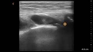 Lateral Meniscus and Knee Effusion  Ultrasound Image Interpretation [upl. by Tnarg]