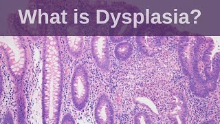 What is Dysplasia  Pathology mini tutorial [upl. by Haroved219]