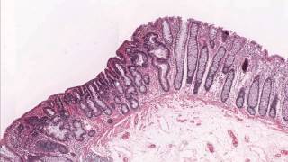 PathDoc15 Colon tubular adenoma demonstrating low grade dysplasia Microscopic diagnosis [upl. by Attennaej]