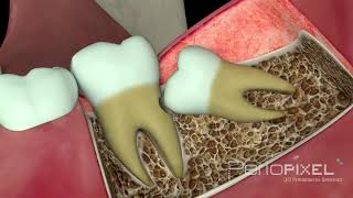 Vídeo 3D Problemas ocasionados por las muelas del juicio  PerioPixel [upl. by Nessim]