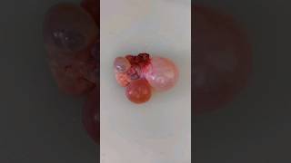 Polycystic ovary grossing video  histopathology uterinefibroid cystitis placentahistology tb [upl. by Giles]