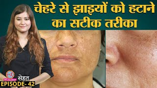 Face पर झाइयां यानी Melasma क्यों होता है और इससे हमेशा के लिए छुटकारा कैसे पाएं  Sehat Ep 42 [upl. by Shien17]