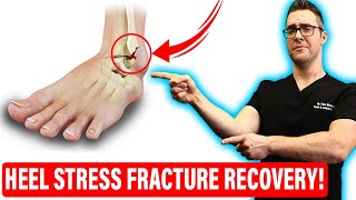 Calcaneus Stress Fracture Treatment Heel Stress Fracture RECOVERY [upl. by Aimaj]