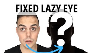 Lazy Eye Fixed amblyopia strabismus [upl. by Hilaire570]