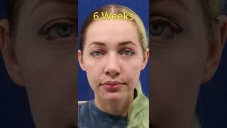 6 Weeks Post Preservation Rhinoplasty [upl. by Guthrey]