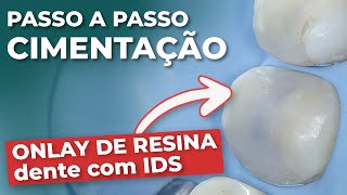 CIMENTAÇÃO ONLAY RESINA COMPOSTA COM IDS  Mylene e Renato [upl. by Bethina]