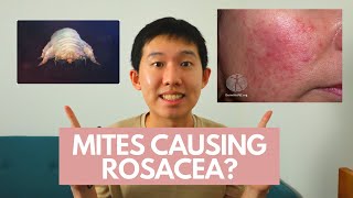 MANAGEMENT OF ROSACEA [upl. by Assirod694]