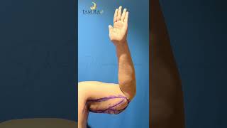 Brachioplasty Before and After  Arm Lift  Tamiralife Chennai [upl. by Nathaniel]