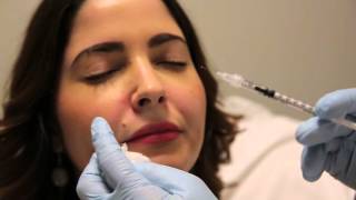 Botulinum Toxin Injection for Gummy Smile [upl. by Eceinaj]