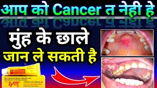 Zytee Rb Gel uses In Hindi  Zytee rb gel  मुंह के चाले की बेस्ट जेल  Doses  Uses  Sideeffect [upl. by Haidabez347]