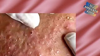 Retirando cravos no rosto  Acne treatment  Vídeo satisfatório 099 [upl. by Knute384]