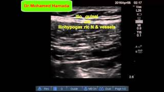 Ultrasound Guided IlioinguinalIliohypogastric Nerve Block [upl. by Teragram]