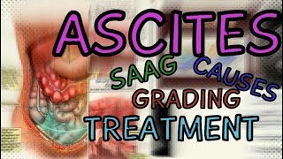 What are Ascites Transudate vs Exudate  SAAG  Fluid Wave Test  Shifting Dullness  Treatment [upl. by Odlavso]