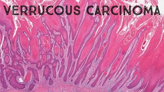 Verrucous carcinoma its NOT caused by HPV pathology dermpath dermatology dermatopathology [upl. by Enoval496]