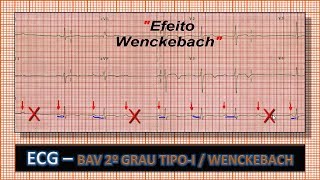 ECG  Eletrocardiograma com BAV 2º Grau TipoI MobitzI ou Wenckebach [upl. by Sterner]