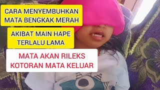 AKIBAT MAIN HP TERLALU LAMA  MATA BENGKAK MERAH SEGERA KOMPRES SUPAYA CEPAT SEMBUH [upl. by Calie]