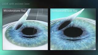 FemtoLASIK vs LASIK with microkeratome [upl. by Kopans556]