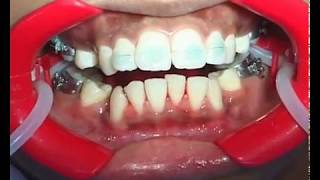 Diagnosis and Management of Malocclusion and Dentofacial Deformities 2e by OP Kharbanda  8 [upl. by Maridel]